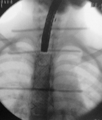 Đặt stent để thức ăn không lọt vào phế quản