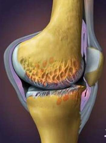 điều trị thoái hóa khớp